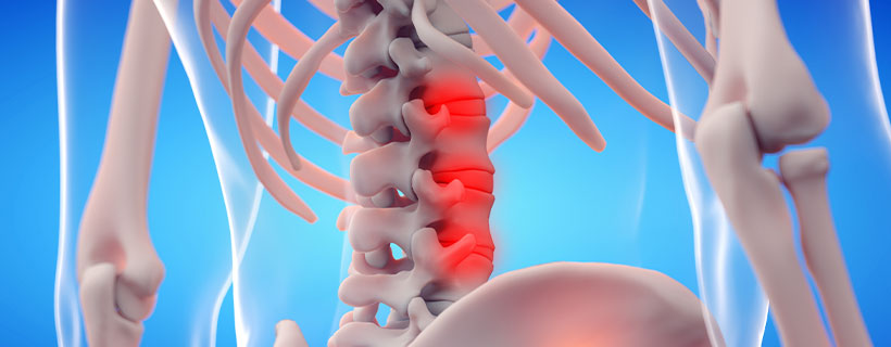 patient needing ankylosing spondylitis treatment in Colville