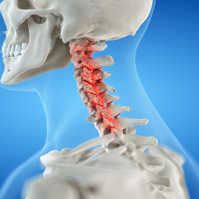 bone spur treatment in Colville WA