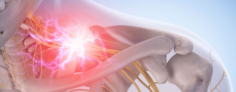 patient needing brachial plexus neuritis treatment in Colville