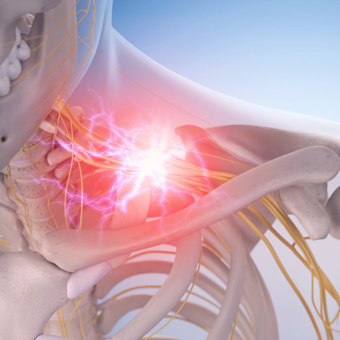 brachial plexus neuritis relief in Colville WA