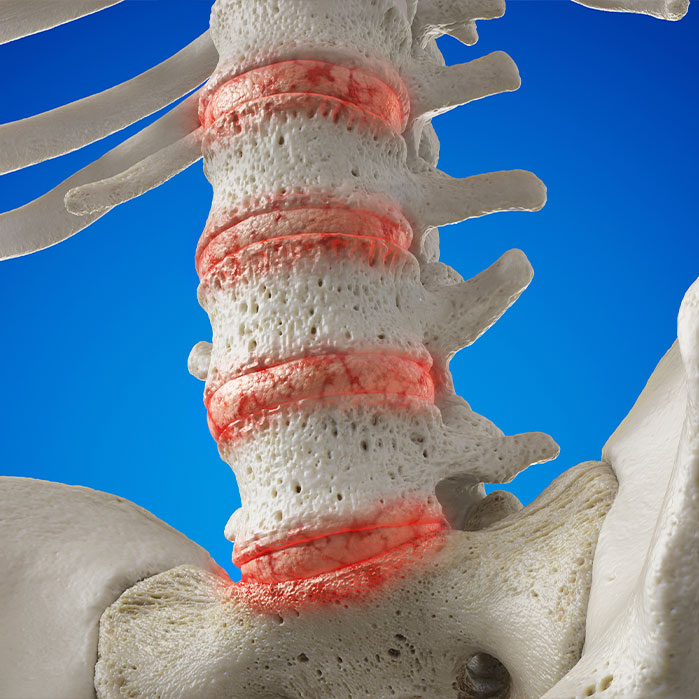 degenerative disc disease treatment in Colville WA