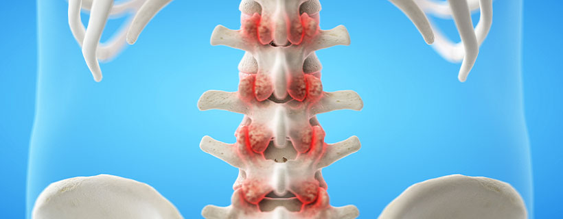 patient needing facet joint syndrome treatment in Colville