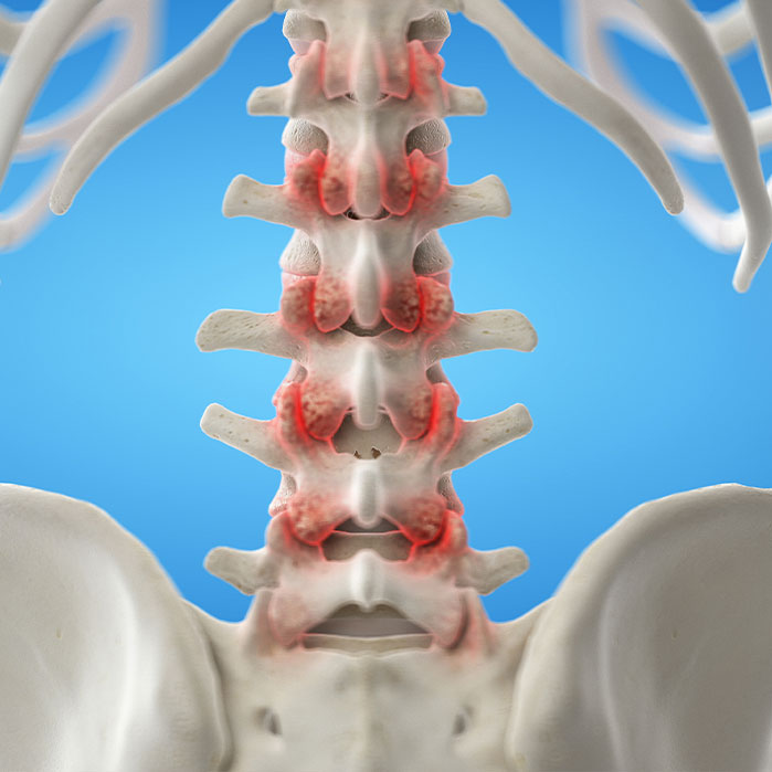facet joint syndrome treatment in Colville WA