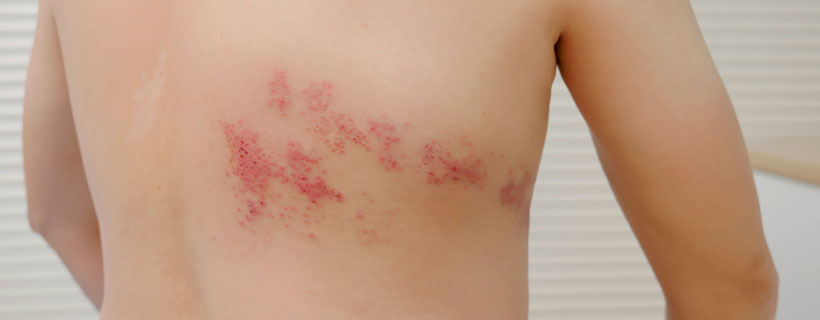 patient needing post-herpetic neuralgia treatment in Colville