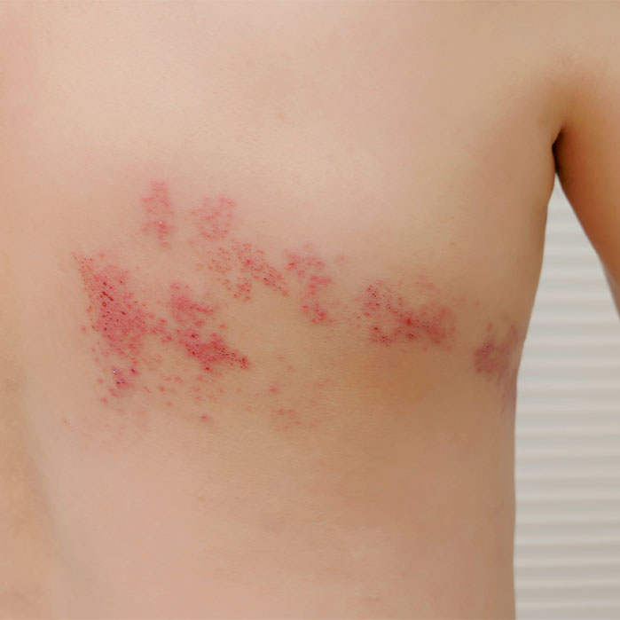 post-herpetic neuralgia relief in Colville WA