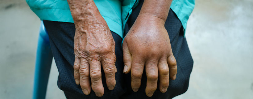 patient needing reflex sympathetic dystrophy treatment in Colville