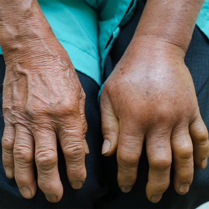 reflex sympathetic dystrophy relief in Colville WA
