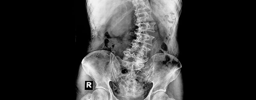 patient needing scoliosis treatment in Colville