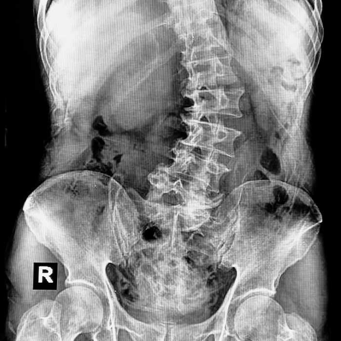 scoliosis chiropractor in Colville WA
