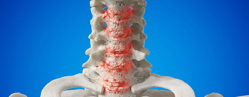 patient needing spondylosis treatment in Colville