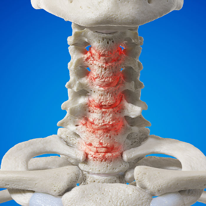 spondylosis treatment in Colville WA