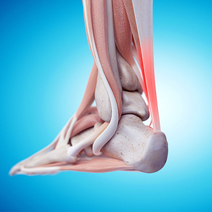 tendonitis chiropractor in Colville WA